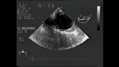 thumbnail of medium Aortendissektion Video